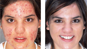skin laser treatment in anna nagar west, mogappaikr, best skin treatment in anna nagar, skin clinic in anna nagar mogappair, best cosmetologist in anna nagar, skin hair, body hair treatment anna nagar & mogappair
