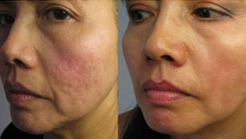 skin laser treatment in anna nagar west, mogappaikr, best skin treatment in anna nagar, skin clinic in anna nagar mogappair, best cosmetologist in anna nagar, skin hair, body hair treatment anna nagar & mogappair