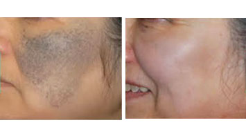 skin laser treatment in anna nagar west, mogappaikr, best skin treatment in anna nagar, skin clinic in anna nagar mogappair, best cosmetologist in anna nagar, skin hair, body hair treatment anna nagar & mogappair