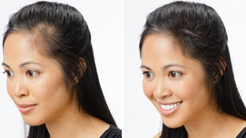 skin laser treatment in anna nagar west, mogappaikr, best skin treatment in anna nagar, skin clinic in anna nagar mogappair, best cosmetologist in anna nagar, skin hair, body hair treatment anna nagar & mogappair